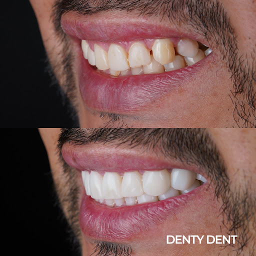 Clínica Dental en Pueblo Nuevo - Denty Dent calle Alcalá - Thumbnail