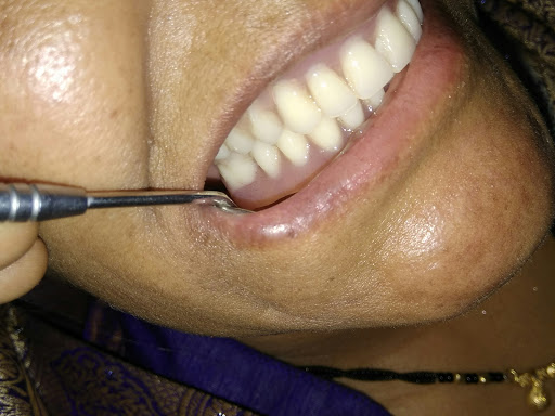 अब न निकलने का टेंशन न बदबू आने का टेंशन लगाकर , भोजन का आनंद लीजिये , फिक्स बत्तीसी post image