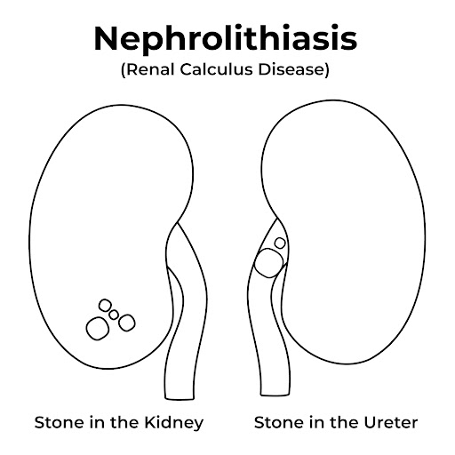 Nephrolithiasis, commonly known as kidney stones, occurs when mineral deposits form in the kidney… post image