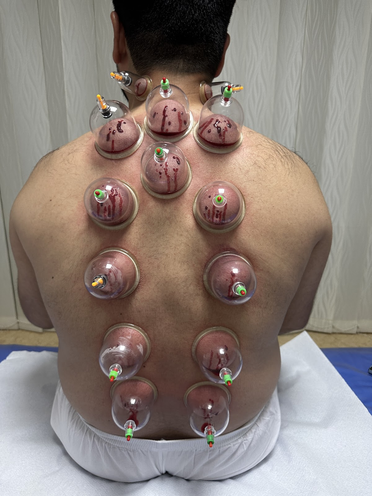 تاج السلطان للحجامة والعلاج الطبيعي - صورة 4