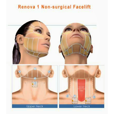 Photos of HIFU Facelift