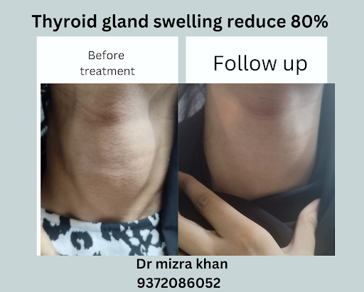 Case of hyperthyroidism... Swelling got reduce... post image