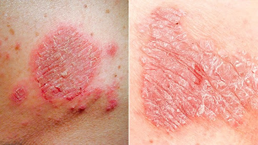 Struggling with persistent skin rashes or plaques? Don't ign