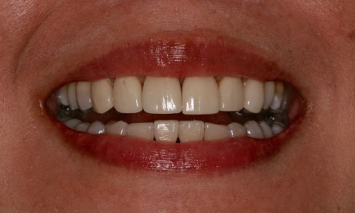 Mission Laser Dentistry | Robert K Faber DDS Inc - Thumbnail