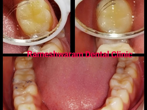 Tooth Colored Fillings post image