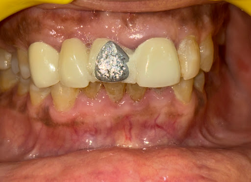 Smile restoration of a patient suffering from low confidence while smiling and social interaction…