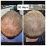 Hair transplant clinic Hair Loss Solutions in Kirkwood
