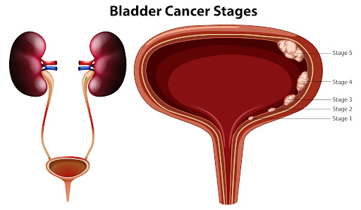 Bladder cancer, also known as urothelial carcinoma, is a condition in which abnormal cells develo… post image