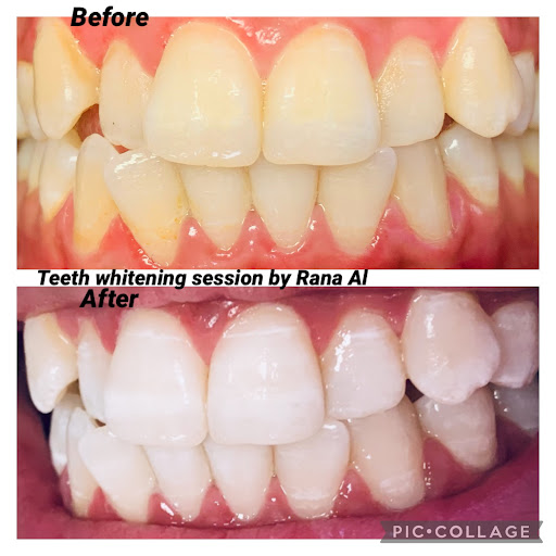 Zoom smile-Rana clinic-Teeth Whitening-Lasers-PRP