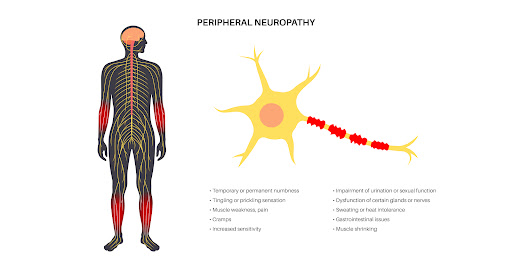 Physiotherapy plays a vital role in treating peripheral neuropathy by enhancing muscle strength,…