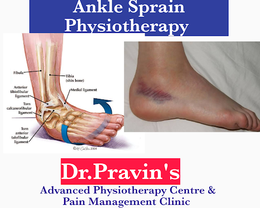 Ankle Sprain post image