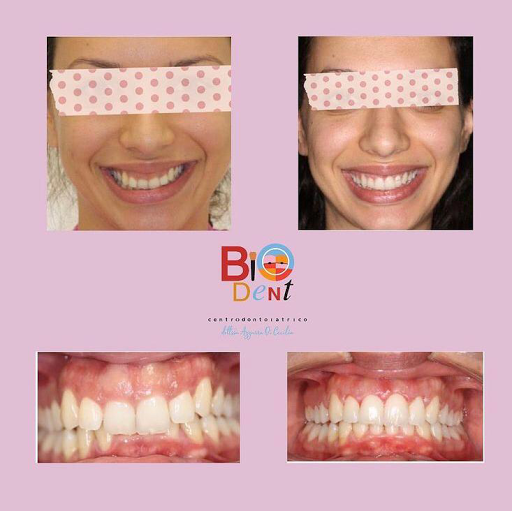 Biodent Napoli - Dr Azzurra Di Cecilia - Invisalign Provider - Thumbnail