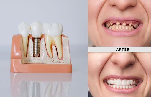 Dental Implant Treatment is a tooth-replacement option designed to restore the appearance and fun… post image