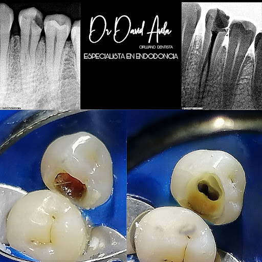 Dr. David Avila - ENDODONCIA - Thumbnail