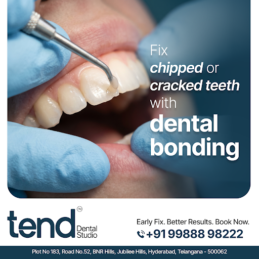 Restore your smile quickly with dental bonding 💫✨ post image