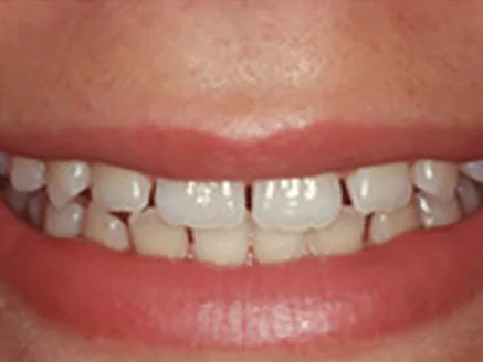 Veneers are coverings that fit over the front surfaces of your teeth. Technicians use high-qualit…