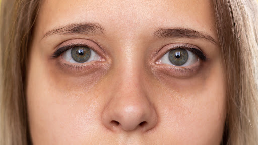 Are you struggling with dark circles under your eyes? Look no further than A & A Medical Mart, yo… post image