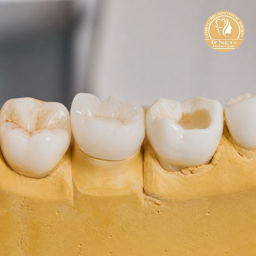 Damaged, broken or decayed teeth can affect your smile, confidence and daily comfort. At Dr Nakra… post image
