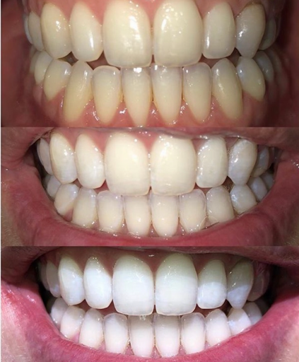 Teeth Whitening Spa 2
