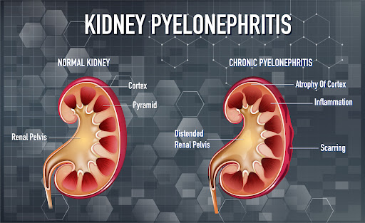 Pyelolithotomy is a surgical procedure used in urology to remove large kidney stones directly fro… post image