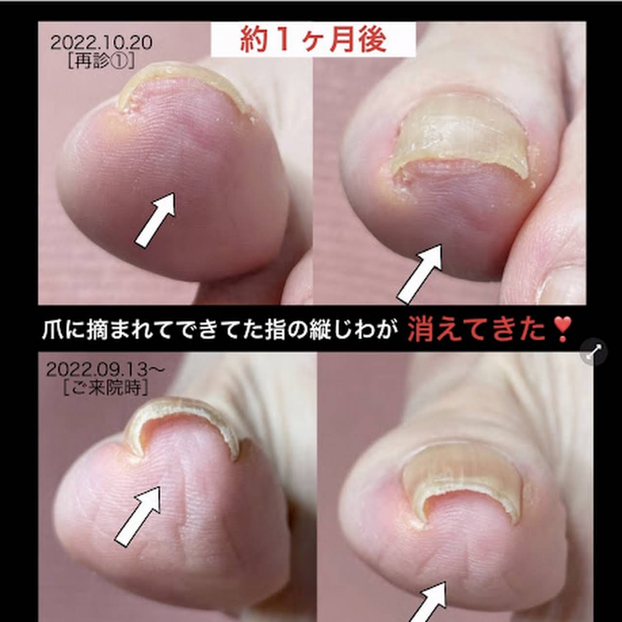 大津 瀬田巻き爪矯正センター 痛くない施術 初回当日で大きな変化 再発を防げる革新的な巻き爪矯正 ツメフラ法