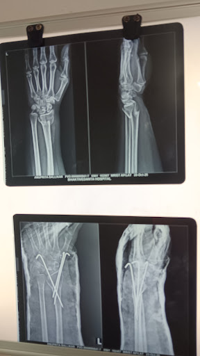Fracture rehab post image