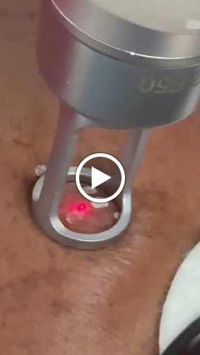 Advanced Melasma Treatment in Progress ✨