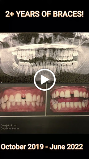 🦷 Braces Treatment | Smile Transformation 😁 post image