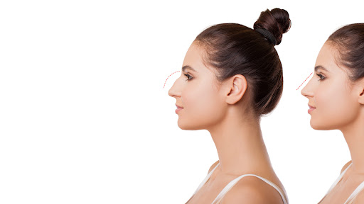 MG Rhinoplasty
