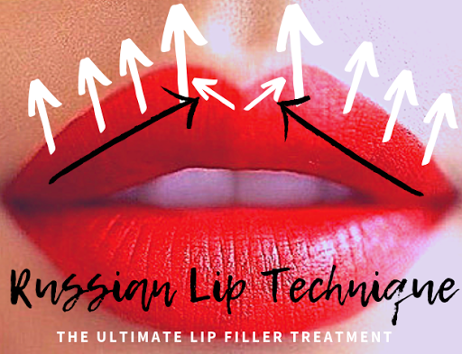 RUSSIAN LIP FILLERS TECHNIQUE