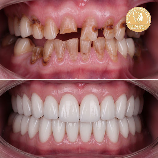 Struggling with broken, worn-out or missing teeth? Full mouth rehabilitation at Dr Nakra's Dental… post image