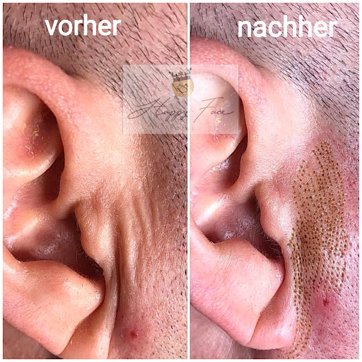 Happy Face Royal Beauty & Ästhetikstudio Fettwegspritze, Microneedling, Hyaluron Pen, Microblading, Plasma Pen uvm - Thumbnail