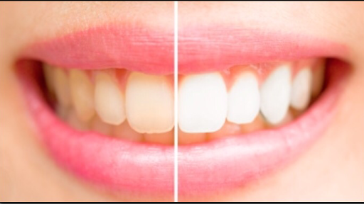 Big White Teeth Whitening