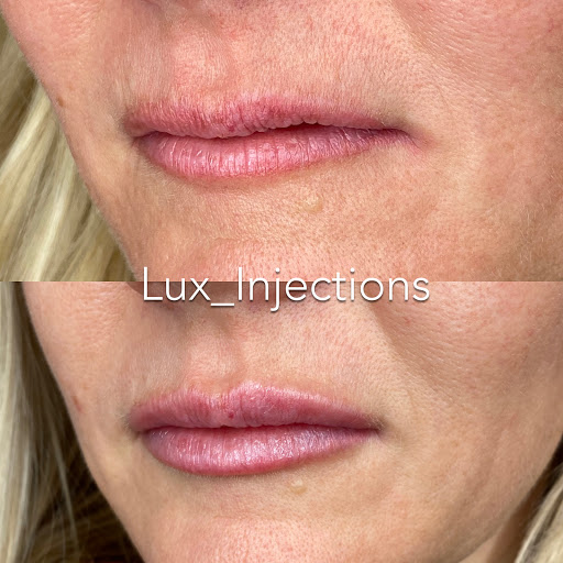 Lux Injections