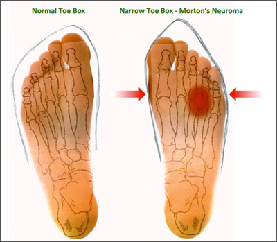 The Center for Morton's Neuroma Gallery - United States