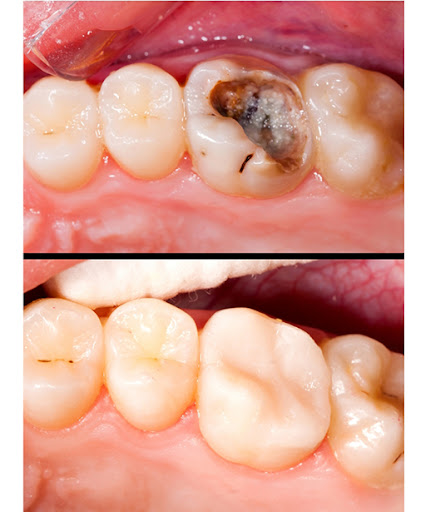 Don't ignore that small hole in your tooth! As seen in our recent case, a simple Dental Filling c… post image