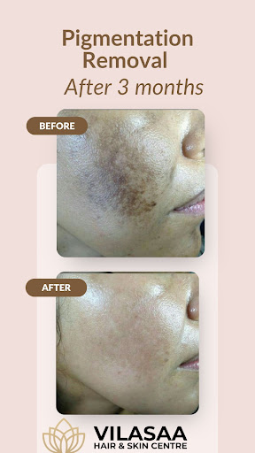 Pigmentation Removal Treatment in Ghaziabad | Vilasaa Hair & Skin Centre