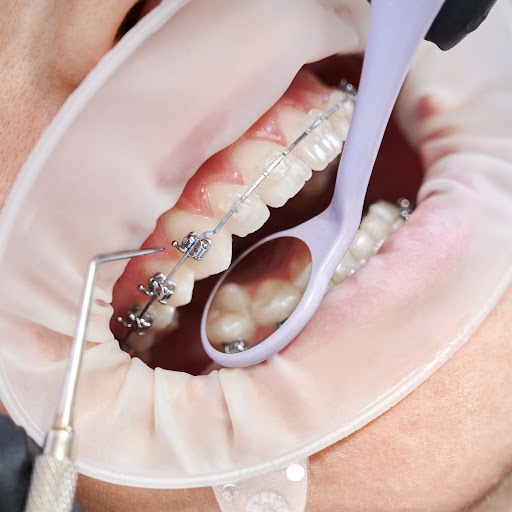Ceramic Braces: A Discreet Solution for Teeth Alignment in Delhi NCR