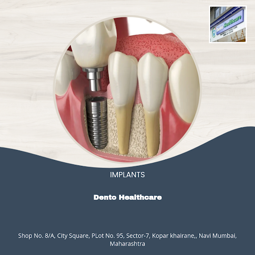 "Experience the best of dental care with Dento Healthcare's implants in Navi Mumbai! Our most lov… post image