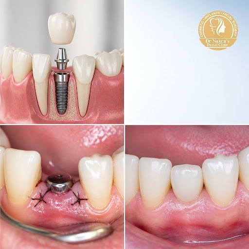 Thinking about dental implants but worried about the procedure and healing time? At Dr Nakra's De… post image