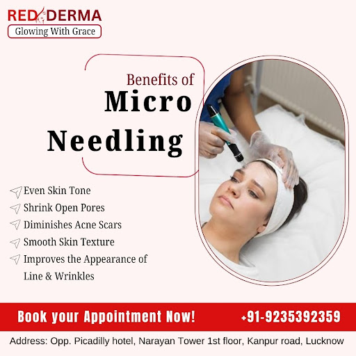 Micro Needling For Even Skin tone & Improves the Appearance of line and wrinkles  at RED DERMA CL… post image