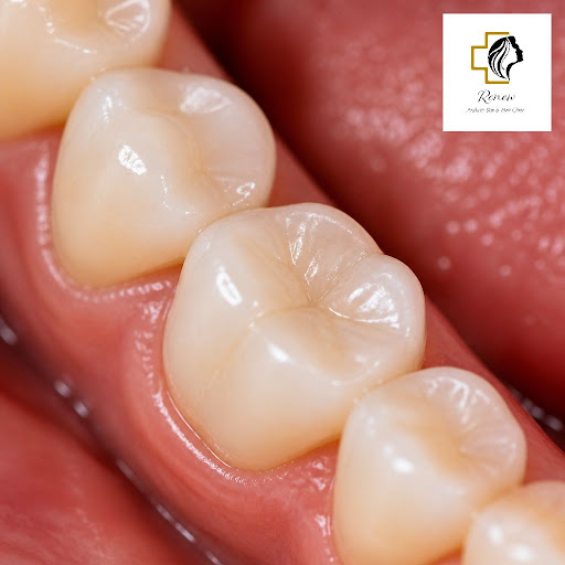 Restore your smile without anyone noticing you’ve had a dental treatment. At Renew Aesthetics and… post image