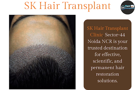 Looking for effective hair treatments? SK Hair Transplant Clinic in Sector 44, Noida NCR, offers…