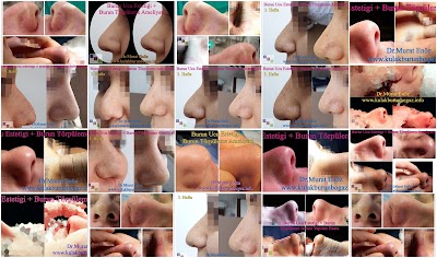 Photos of Dr. Murat En&ouml;z, ENT Doctor, Burun Estetiği, Tip Plasty, Rhinoplasty, Nose Job Surgery, Istanbul