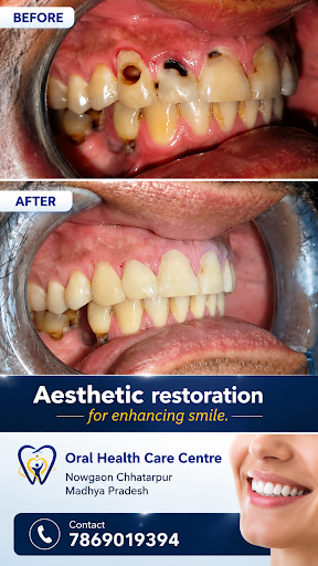 Smile Makeover with Aesthetic Restoration post image