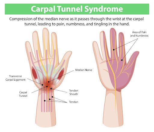The carpal tunnel is a narrow passageway in the wrist that houses the median nerve. When this ner… post image