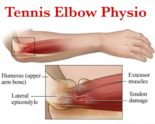 Tennis Elbow Physio Expert Treatment in Vikhroli, Mumbai post image