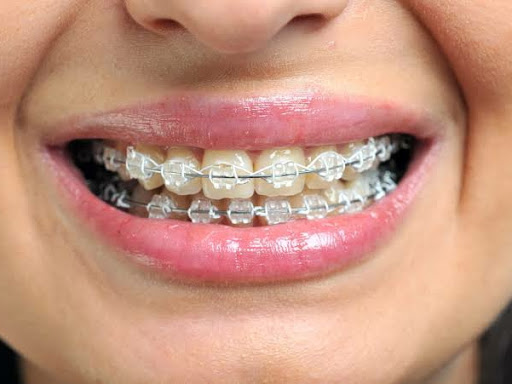 Fixed orthodontic treatment,(treatment of malaligned teeth) post image