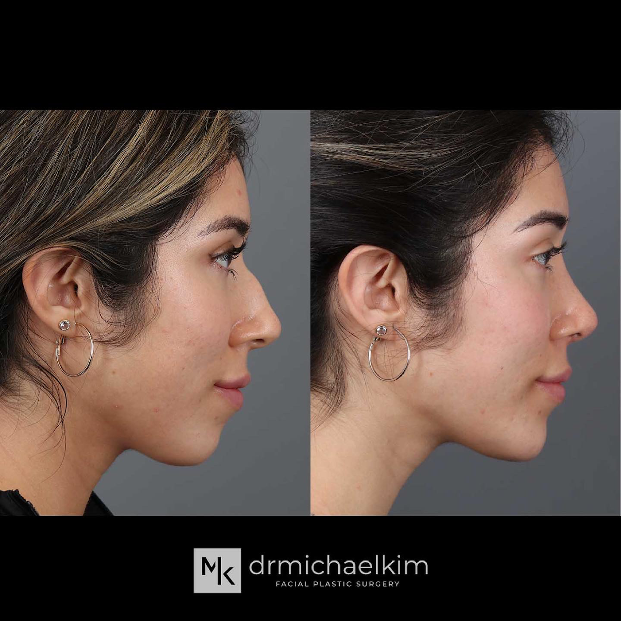 Ultrasonic Rhinoplasty Overview: Cost, Recovery, Before & After - AEDIT