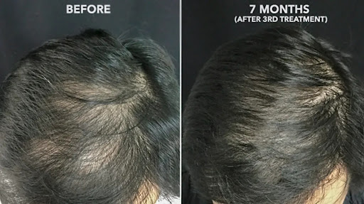 Hair Fall Is Treatable post image